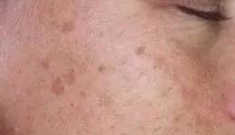 各种面部斑图片,如何辨别脸上的斑