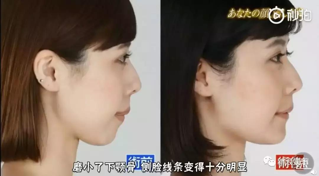 那些整容脸真的觉得自己好看吗,为什么整容以后都是一样的网红脸