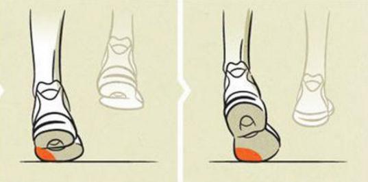 足内翻导致足弓疼,足内翻会导致什么腿型怎么改