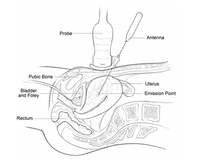 看看痛不欲生的子宫腺肌症痛经专业领域的看法与典型病例