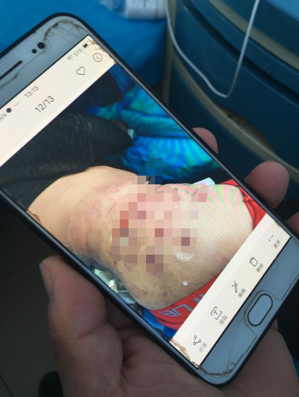 河南杞县115人针灸后针眼溃烂：针灸前被注射药物，事发后仍有人苦求继续针灸，患者需手术切开伤口排脓