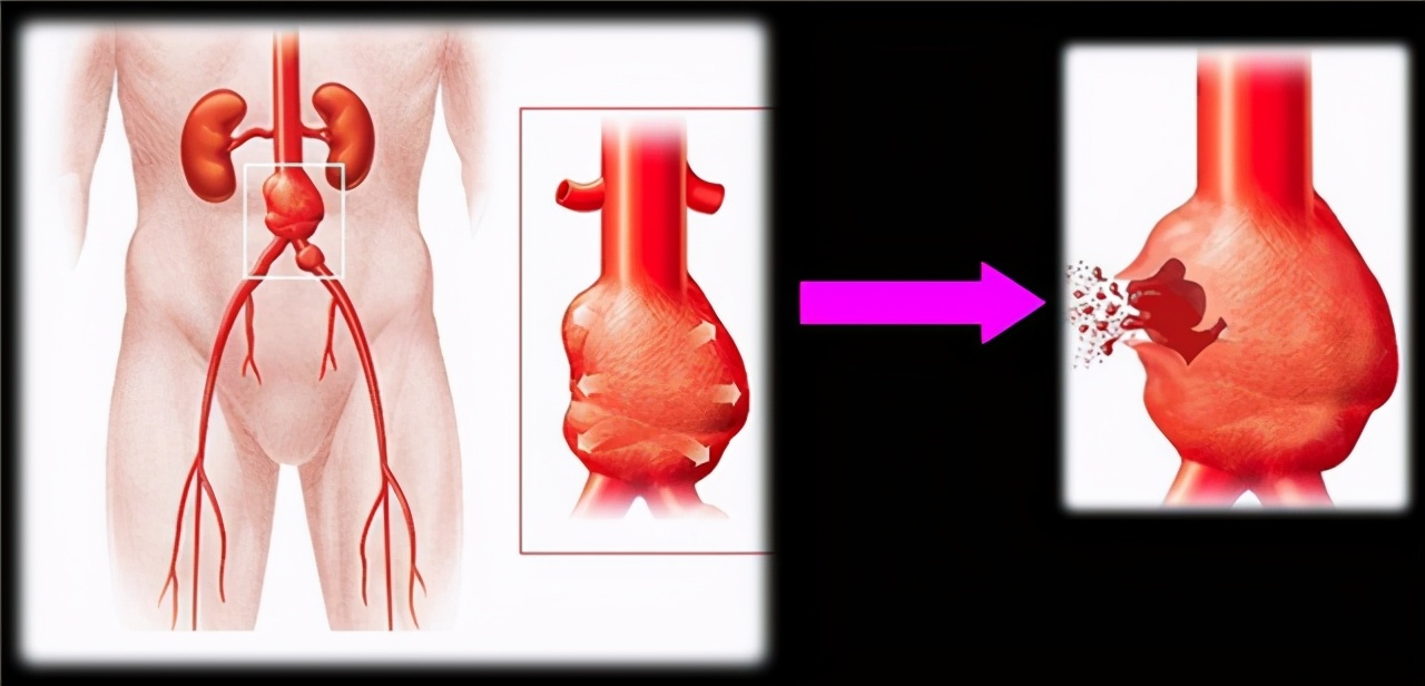 血管里面长瘤严重吗,血管里有肿瘤会发展成恶性的吗