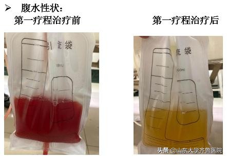 中国首创载药囊泡治疗,山东齐鲁医院自己研制的药