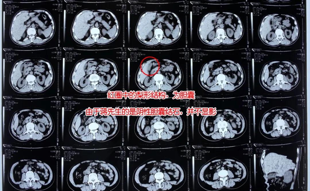 湖南​男子对肉食“情有独钟”，结果胆囊养出300颗“豆子”