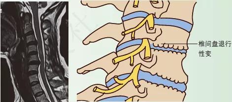 颈椎生理曲度变直有骨刺怎么办,颈椎x线片能看到什么吗