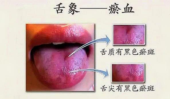 长期的瘀血,长期气滞血瘀的症状