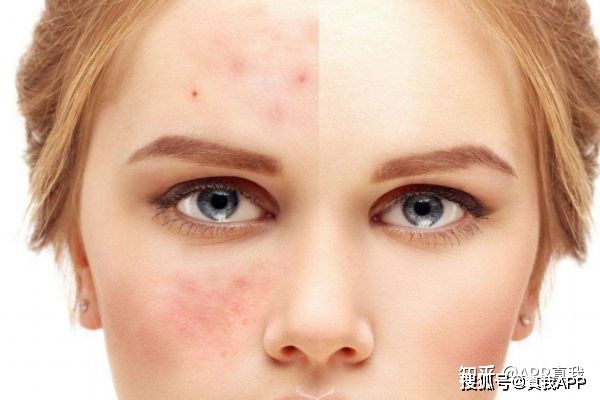 脸刷酸可以祛痘印吗,祛痘印刷什么酸