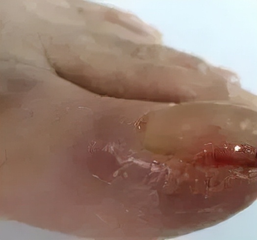 靶向药引起皮肤溃烂擦什么药膏好,靶向药导致的皮肤毒性该怎么治疗