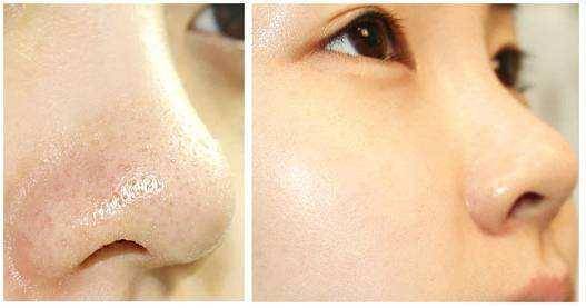 刷酸到底好不好,美容刷酸的副作用是什么