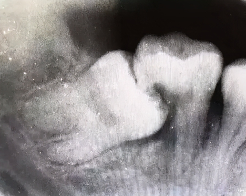 有没有智齿不拔的案例,我有个智齿没长出来怎么拔