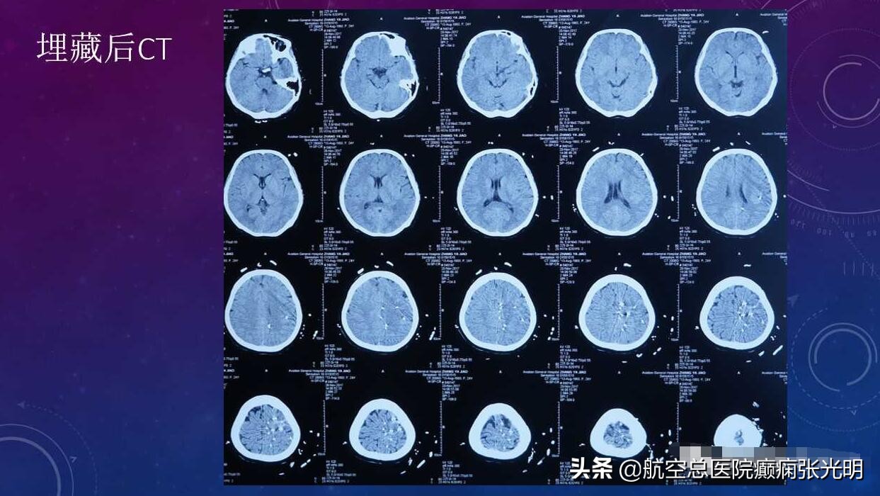 张光明左颞叶癫痫手术成功率,张光明谈治疗癫痫的方法有哪些