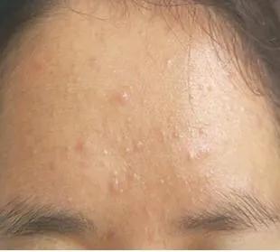 额头发际线长痘是什么原因,更年期额头长痘是什么原因