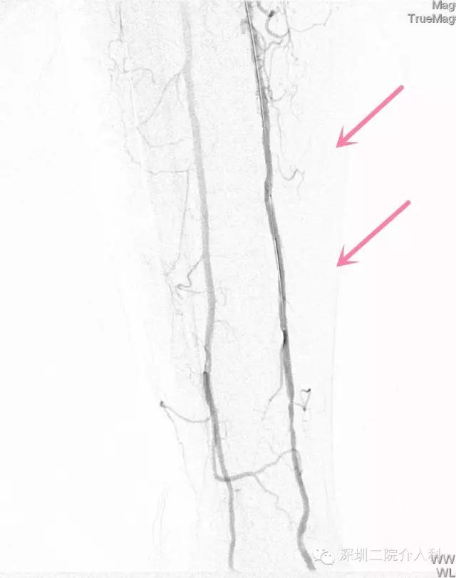 糖尿病下肢血管病变介入治疗,糖尿病足血管介入