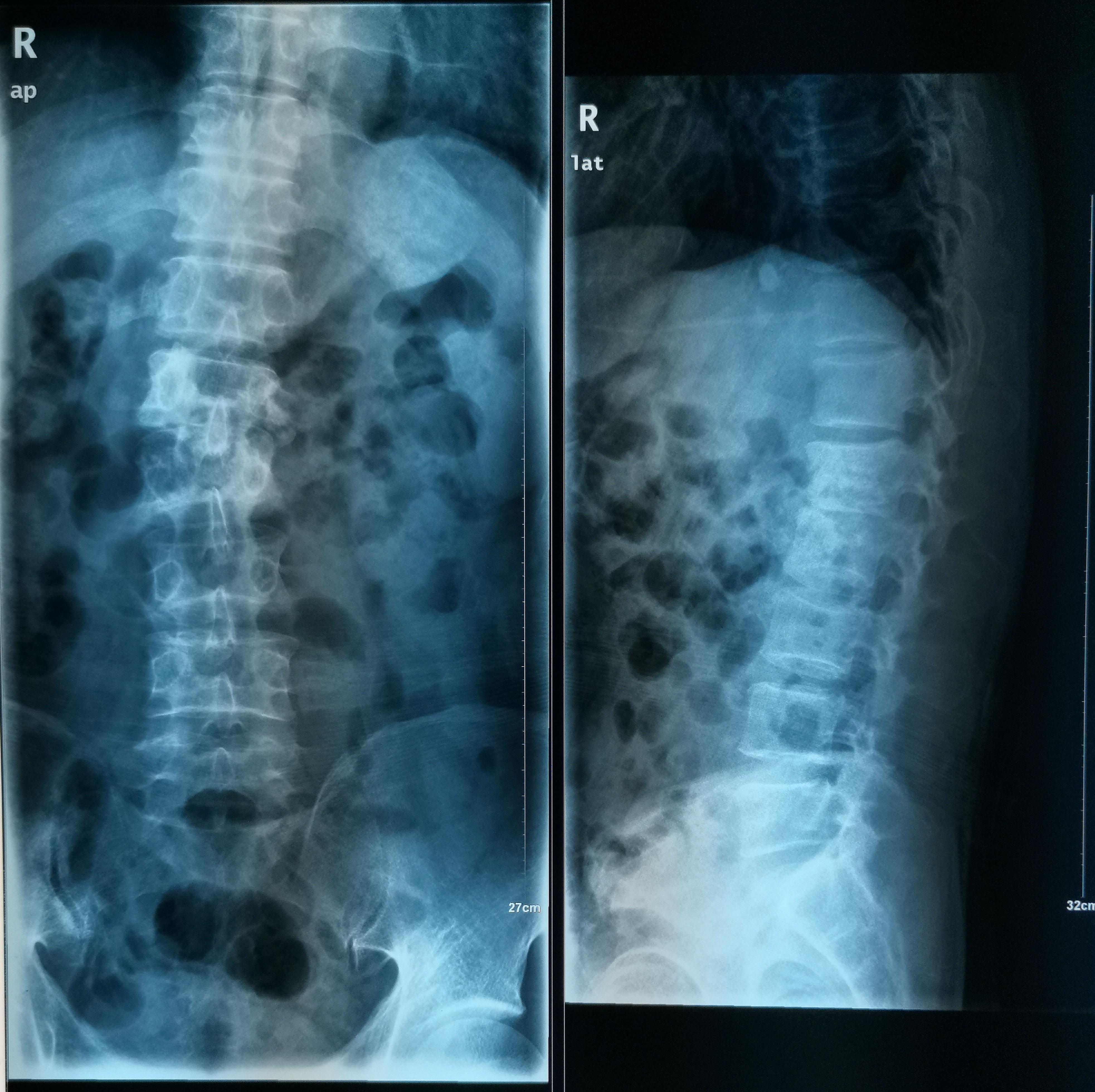 老年人脊柱歪了怎么办,成年人脊柱歪了的危害