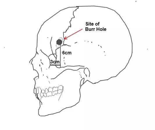 正常人被送进精神病院电击治疗,被送去精神病院电击治疗