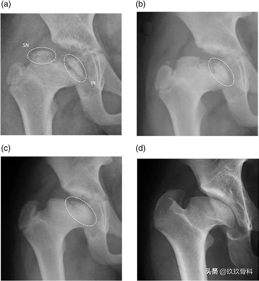 髋膝关节文献精译荟萃