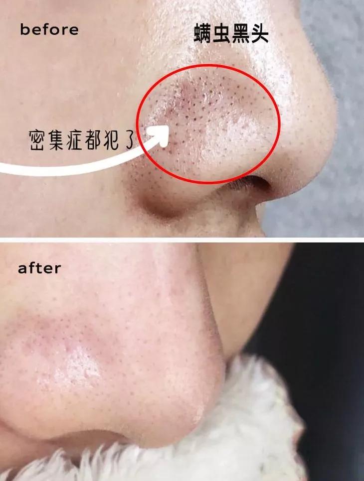 专治螨虫的洗面奶,螨虫专用洁面乳