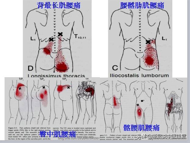 激痛点挂图,激痛点疗法笔记