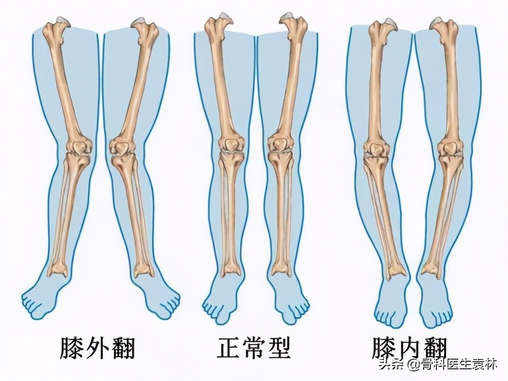 为什么年纪一大腿就容易变形为什么年纪大了腿就不如以前的直了