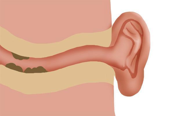 有油耳朵狐臭几率大吗,油耳朵腋下狐臭怎么根除视频