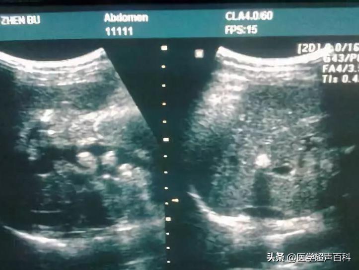 肝内钙化灶和肝内胆管结石相鉴别,肝内胆管结石与肝内钙化点的区别