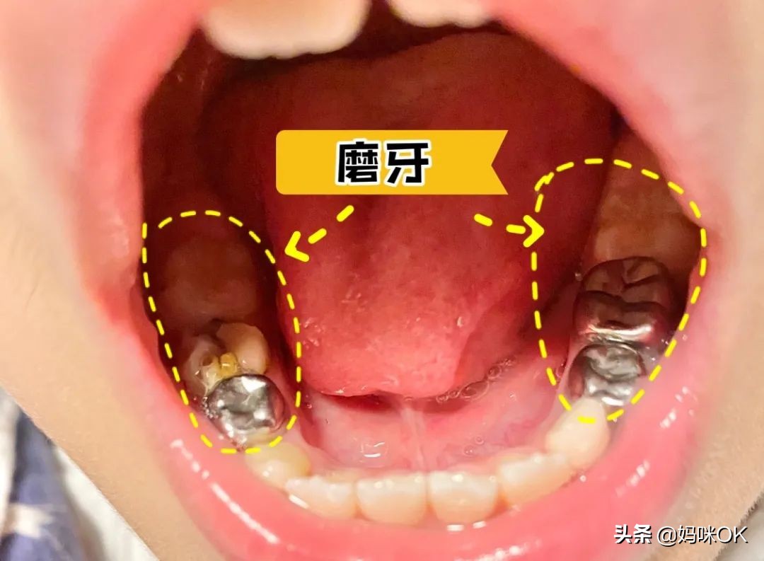 每个饱受“蛀牙”折磨的妈妈都走上了这条路……