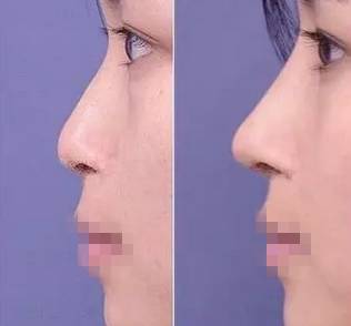 你知道什么是玻尿酸吗,如何快速了解玻尿酸品类