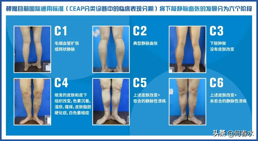 作为教师怎么避免静脉曲张,老师如何防止腿部静脉曲张