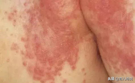 宝宝红屁股看着好心疼!戳这里,给你最全有效的红屁股治疗方法