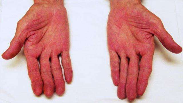 蜘蛛痣和肝掌是什么原因引起的,肝掌跟蜘蛛痣形成的原因