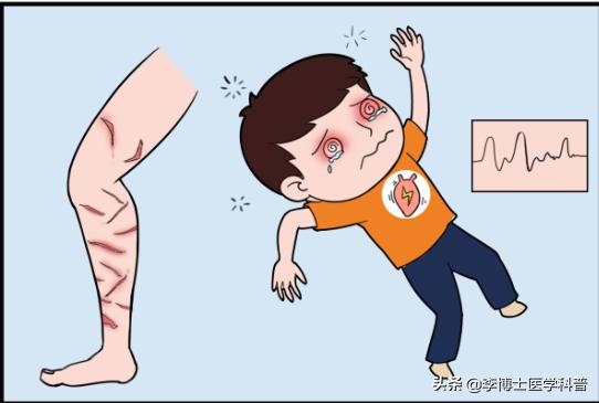 被水母蛰伤后处理视频英文,被水母蜇科普动画