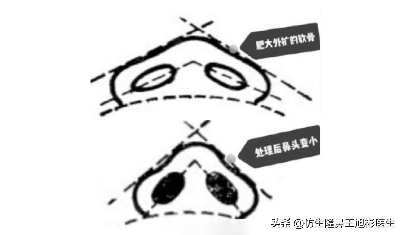 隆鼻鼻头大是失败了吗,大鼻头隆鼻手术案例