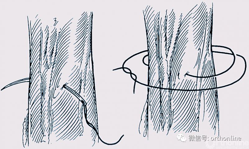 常用的手术缝合方法图,临床常见常用伤口缝合方法