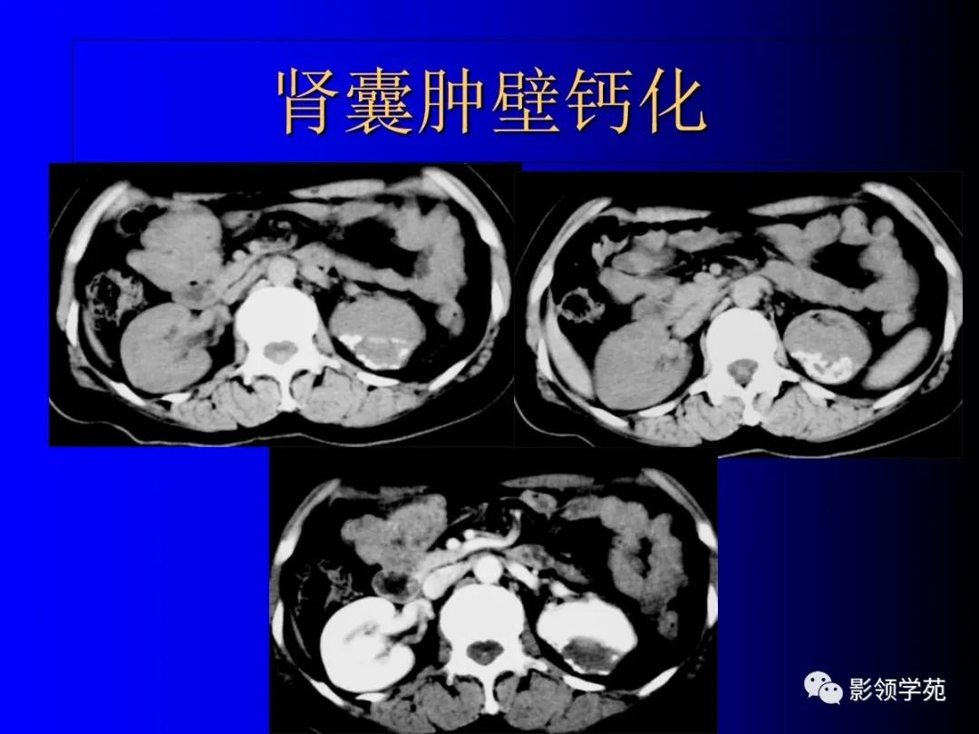 肾脏囊性肿块的影像学特点,肾脏典型病理图片及解析