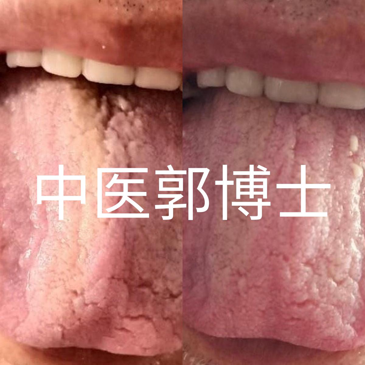 中风平肝潜阳,中风能吃中药调理吗