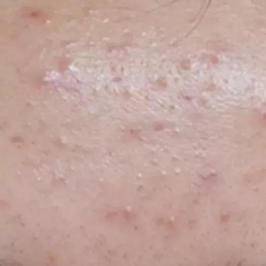 激光祛痣后悔吗,激光祛痣没掉反而更大