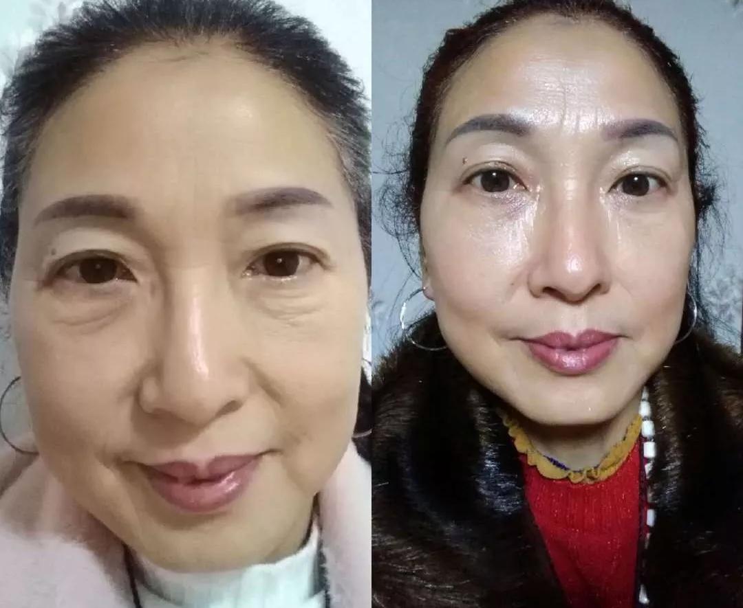 眼袋越来越严重怎么救,有眼袋显老十岁一招教你消除