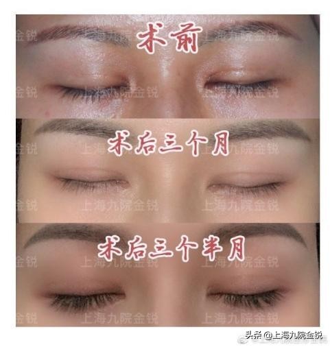 双眼皮VS单眼皮，为什么更多人喜欢双眼皮？