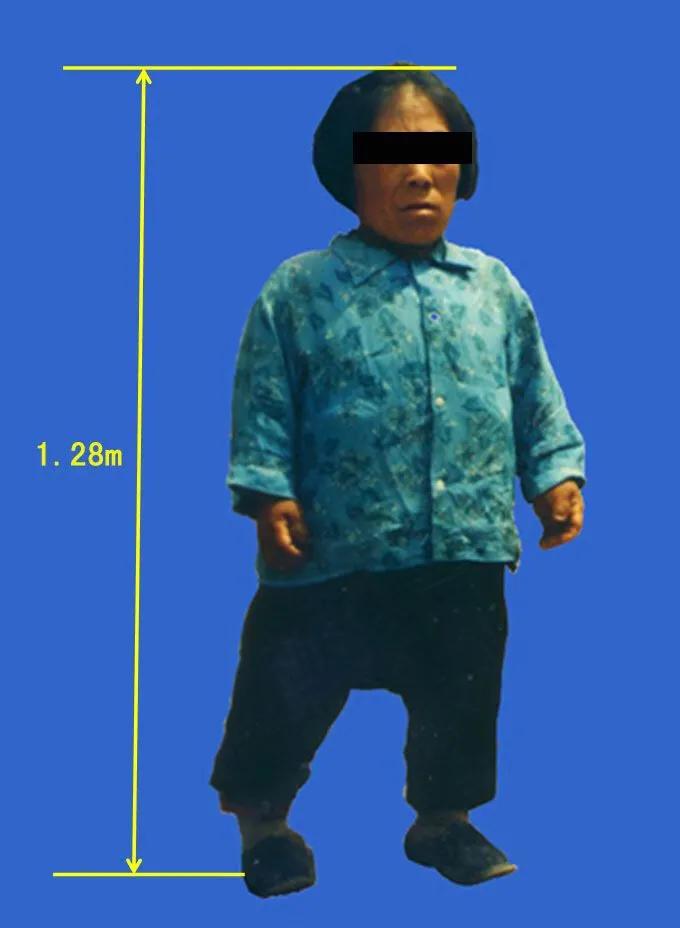 大骨节病科普视频,关于膝盖痛你了解多少