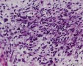 胚胎横纹肌肉瘤是怎么形成的,横纹肌肉瘤转移全身能活多久