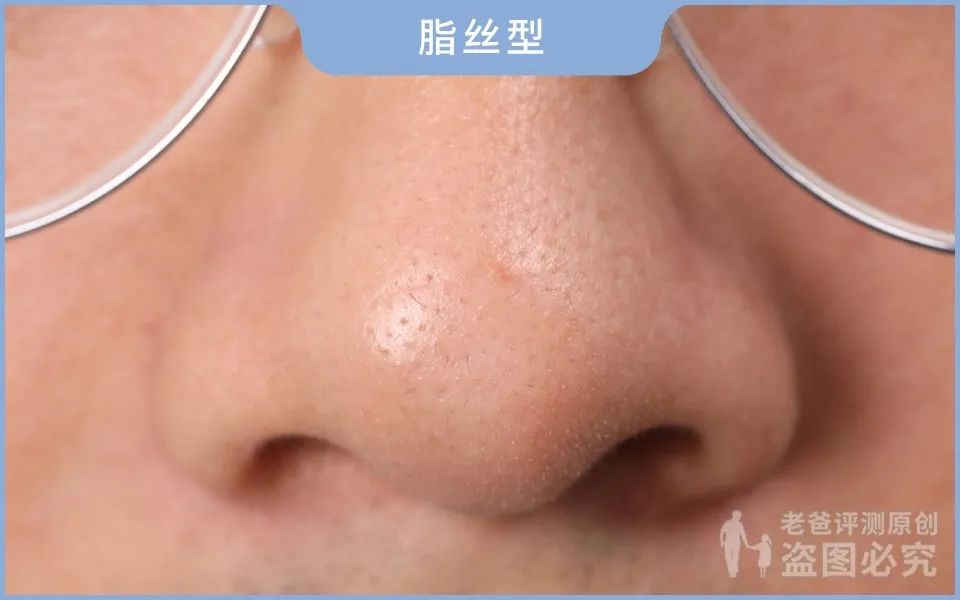 如何用简单的方法去黑头真实有效,别挤了教你去黑头的正确方法