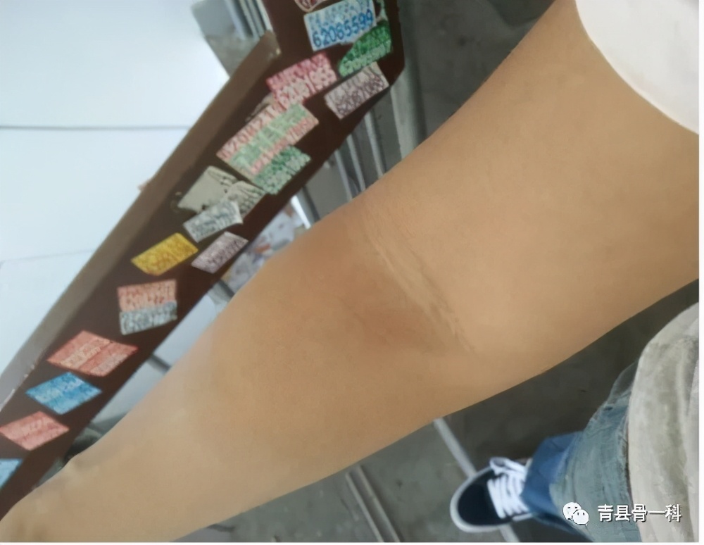 手指肌腱断裂怎么连接,小指第一节肌腱断裂肌腱粘连症状