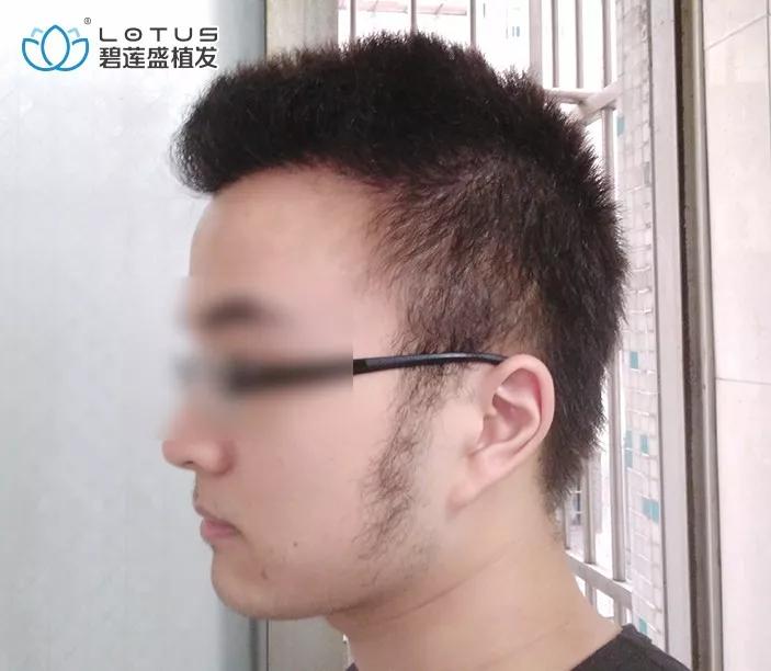 发际线后移额角大头发稀疏怎么办,额角发际线还能恢复吗