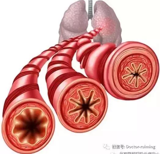 慢支肺气肿与慢阻肺的区别,慢支慢阻肺肺心病治疗原则