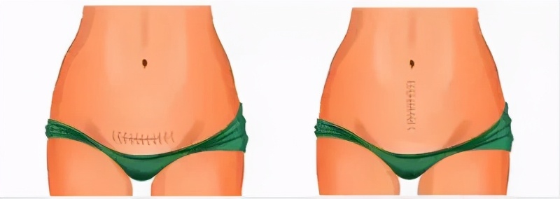 杜淳老婆是剖腹产吗,杜淳体验分娩