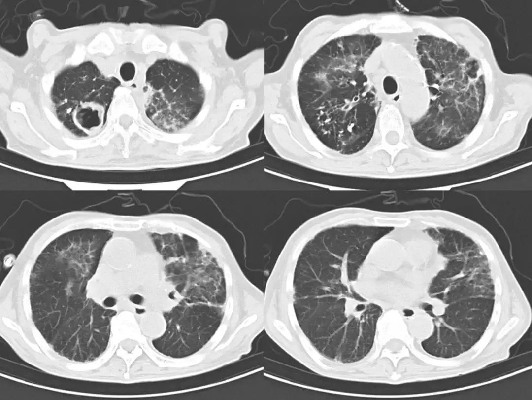 不明原因胸腔积液案例,胸腔积液病例