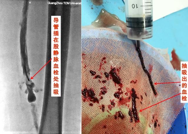静脉曲张、静脉血栓，有区别？有联系？要处理？请听专业的回答