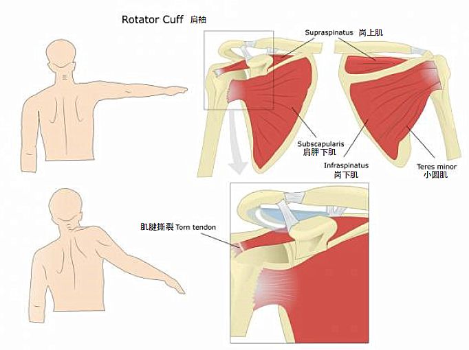 胳膊与肩膀相连处疼痛是什么原因,肩膀像挑担子一样疼痛是什么原因