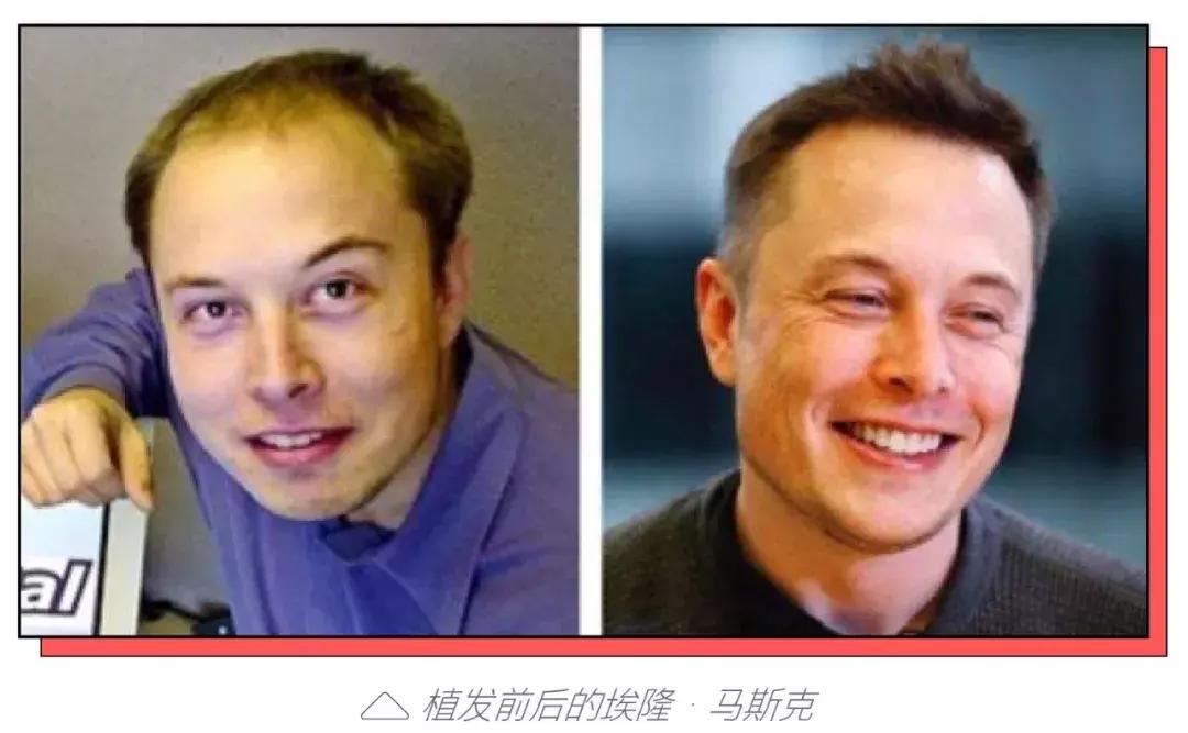 90后秃头开始被资本收割了,90后秃然崛起你们的发际线还好吗