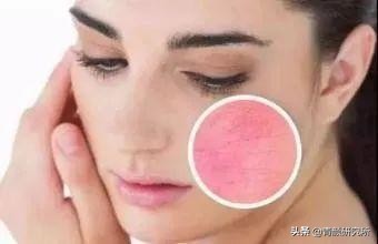 修复角质层薄红血丝敏感肌擦什么,角质层薄红血丝敏感肌肤用什么药